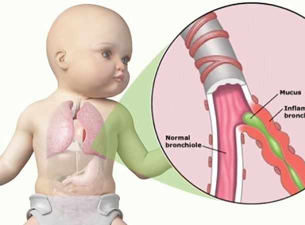 Βρογχιολίτιδα