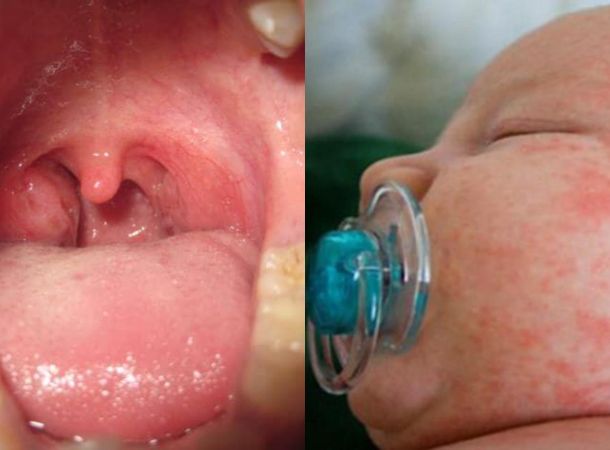 Στρεπτόκοκκος της ομάδας Α