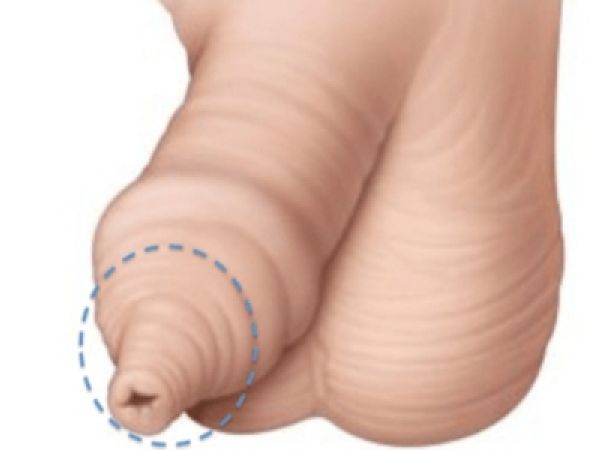 Φυσιολογική νεογνική φίμωση ή don't touch