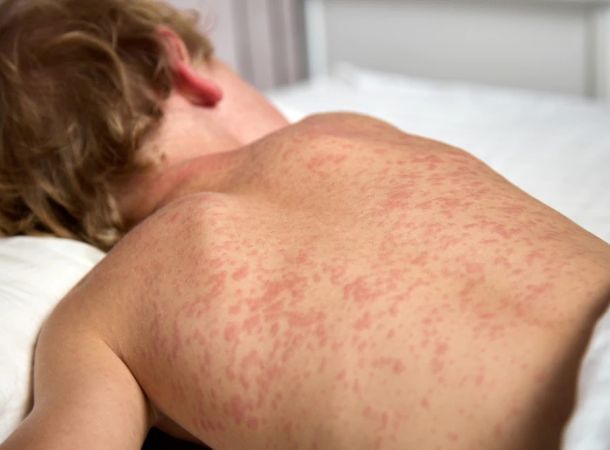 Αιφνίδιο Εξάνθημα