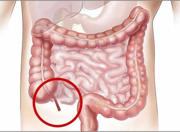 Σκωληκοειδίτιδα